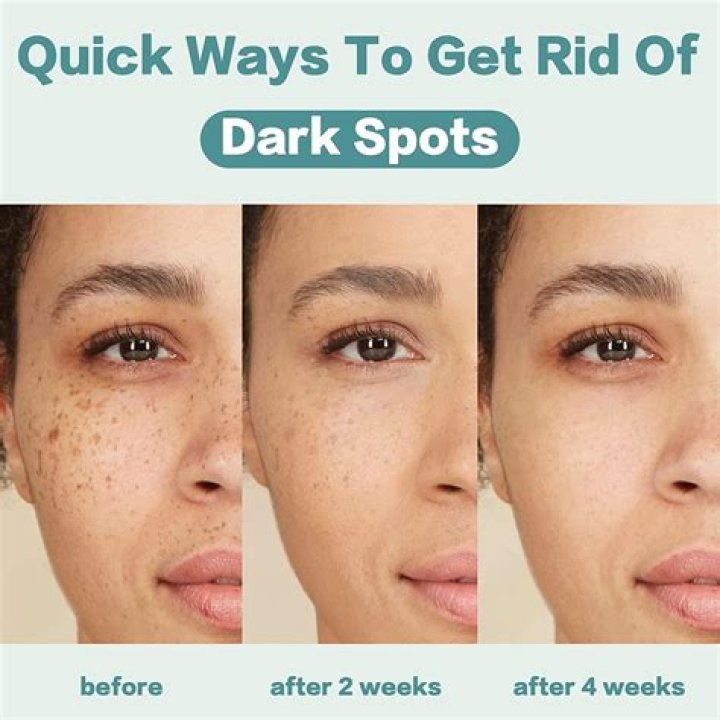 Best Dark Spot Remover for Face: Your Ultimate Guide to Radiant Skin