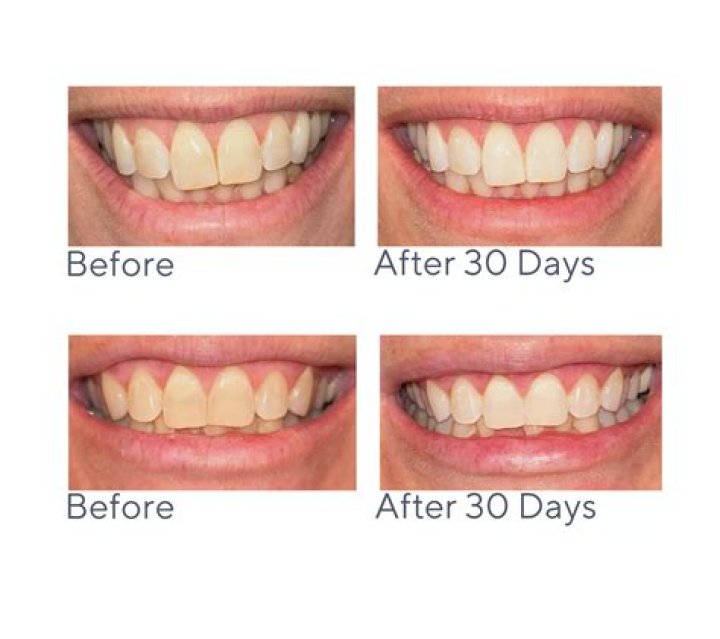 Comprehensive Smileactives Reviews: A Complete Guide to Whiter Teeth